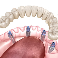 All-on-4-dental-implant