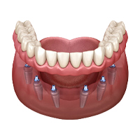 All-on-6-dental-implant-1