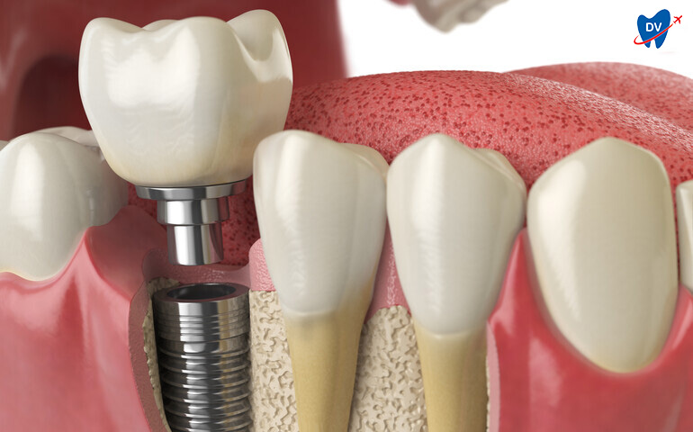 Dental-Implants-1