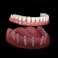 Dental-Implants