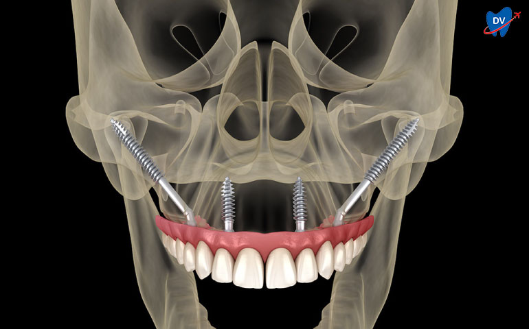 Zygomatic-Implants